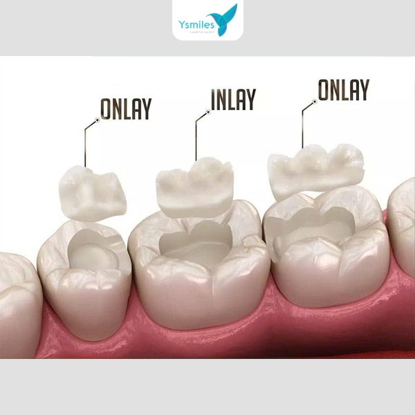 Trám răng giúp răng chắc khỏe, trắng sáng và hạn chế mảng bám hiệu quả