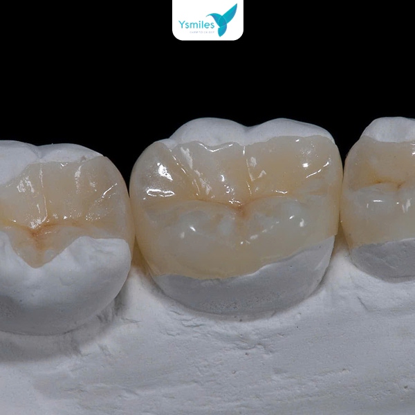 Trám răng với cách giảm đau ê buốt hiệu quả