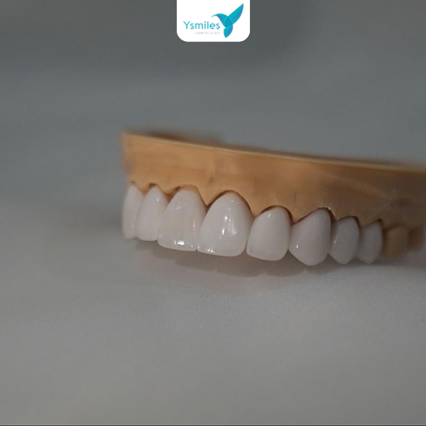 Chăm sóc răng sau trám răng bền lâu hiệu quả