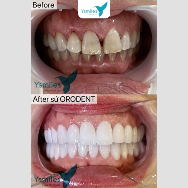 Một số điều cần lưu ý khi chọn nha khoa bọc răng sứ thẩm mỹ