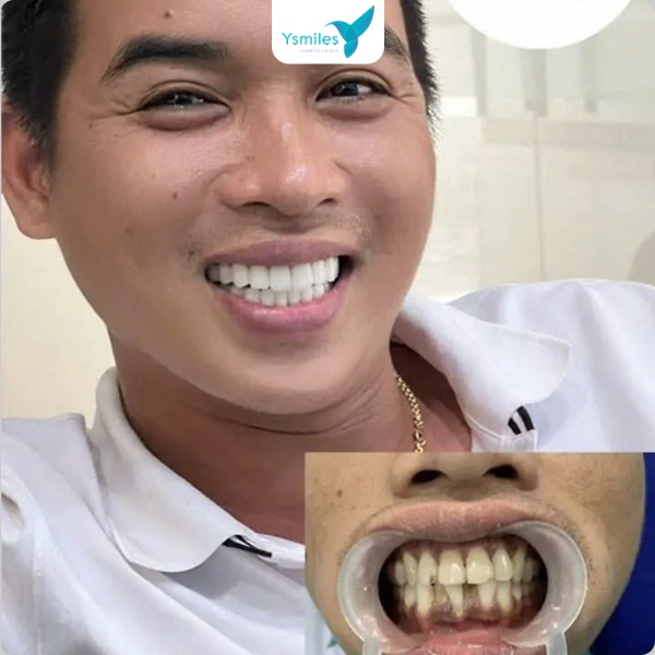 Ysmiles nha khoa bọc răng sứ thẩm mỹ được khách hàng tin chọn hàng đầu hiện nay