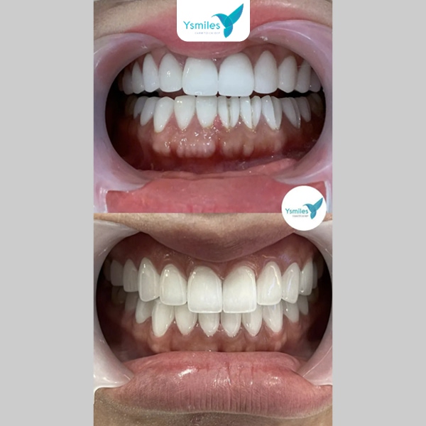 Chi tiết quy trình bọc răng sứ thẩm mỹ tại Ysmiles