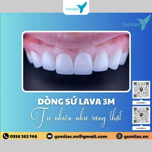 Tham khảo từ vấn từ bác sĩ để chọn loại sứ phù hợp