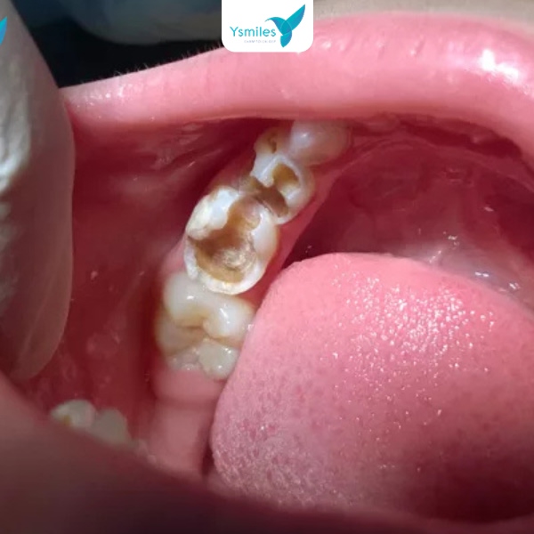 Điều trị chỉnh nha chức năng giúp điều chỉnh kịp thời các sai lệch về khớp cắn