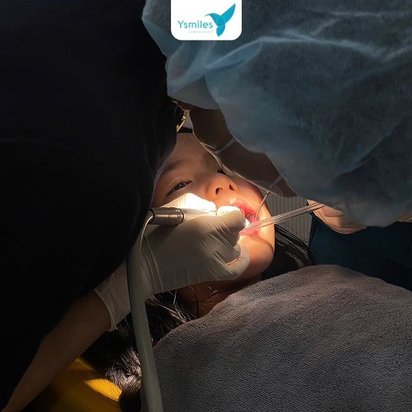 Ysmiles nha khoa nhổ răng sữa cho bé uy tín