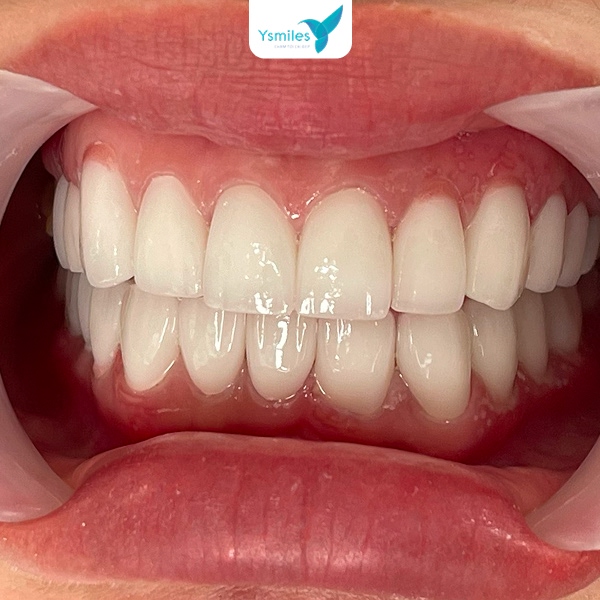 Chọn dáng răng sứ thẩm mỹ phù hợp là điều kiện tiên quyết giúp kiến tạo nụ cười hoàn hảo