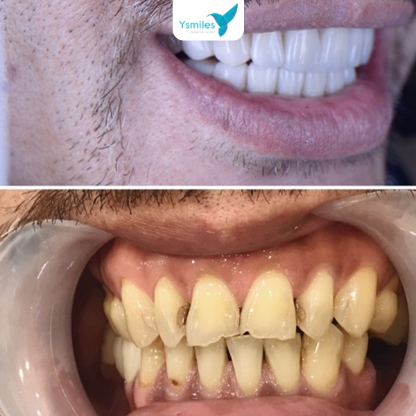 Tự tin nhân đôi với dáng răng sứ thẩm mỹ và màu răng phù hợp