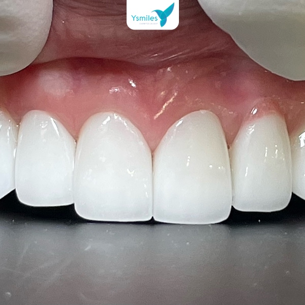 Cân nhắc lỹ lưỡng để chọn dáng răng sứ thẩm mỹ phù hợp cho khuôn mặt của mình