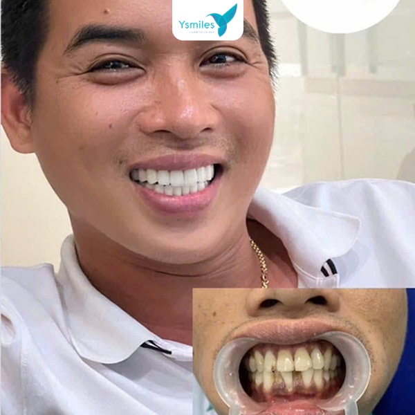 Răng sứ thẩm mỹ giúp bạn cải thiện chức năng ăn nhai hiệu quả 