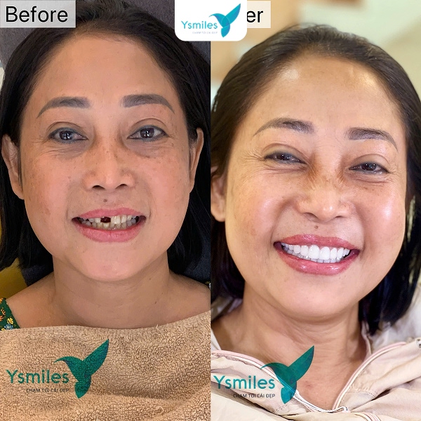Ysmiles địa chỉ bọc răng sứ thẩm mỹ uy tín bạn nên cân nhắc