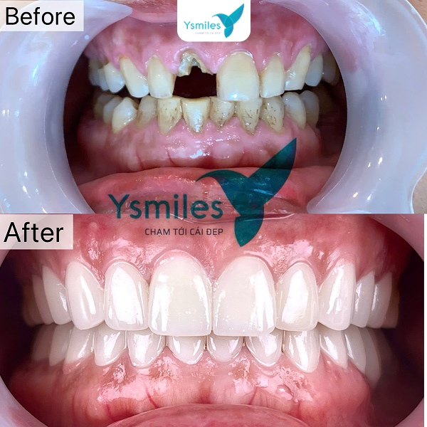 Cận cảnh hàm răng sứ thẩm mỹ hoàn hảo, mang lại nụ cười trắng sáng tự nhiên
