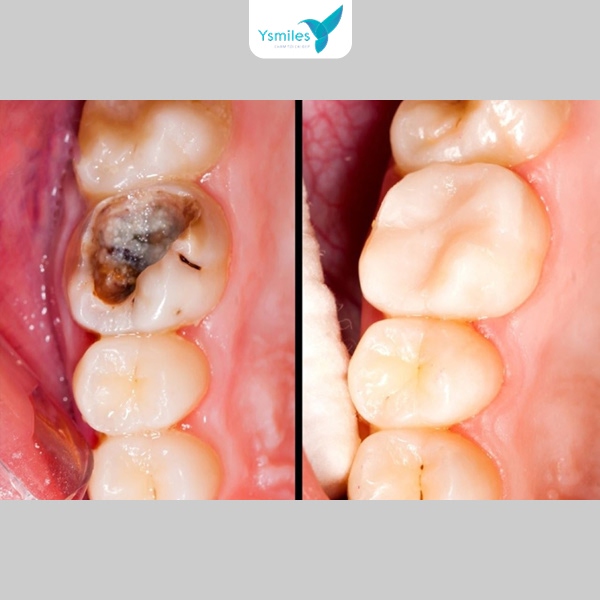 Thực hiện kỹ thuật trám răng để lấp đầy lỗ sâu