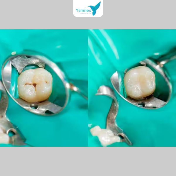 Răng bị sâu trước và sau khi trám răng thành công