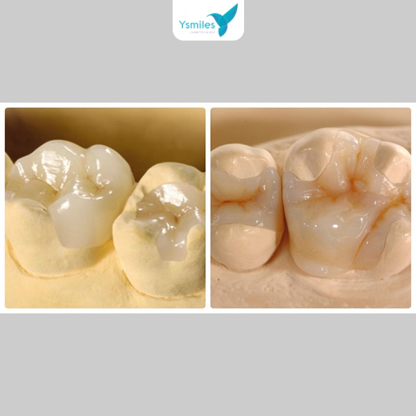 Răng được trám răng bằng composite hoặc phục hình sứ thẩm mỹ