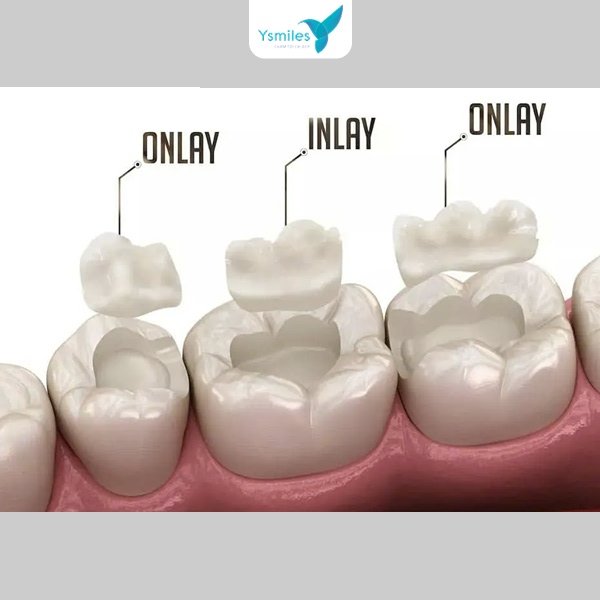 Ysmiles cam kết trám răng chất lượng thẩm mỹ cao