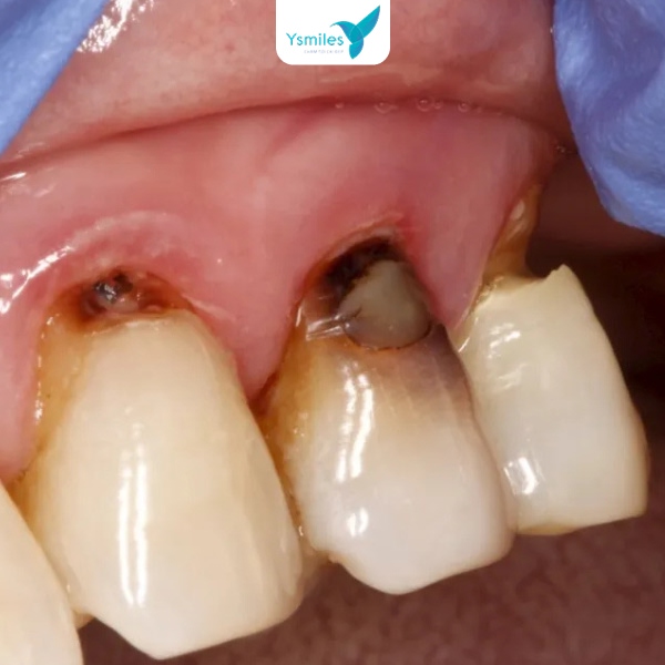 Lỗ sâu răng cần được can thiệp bằng phương pháp trám răng sớm