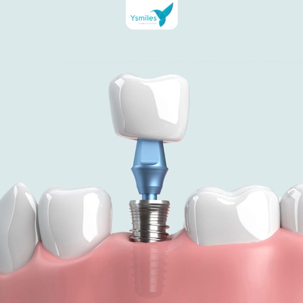 Quy trình trồng răng implant chuẩn y khoa