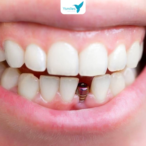 Trồng răng Implant phục hình răng thẩm mỹ và hiệu quả 