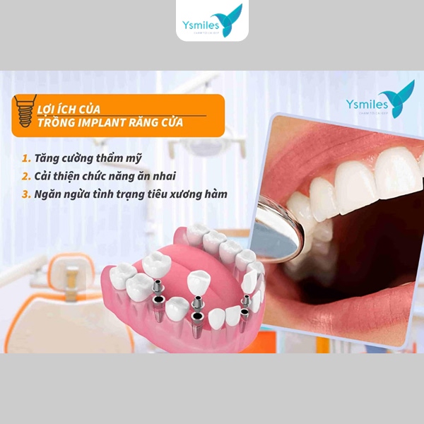 Trồng răng Implant mang đến nhiều lợi ích vượt trội