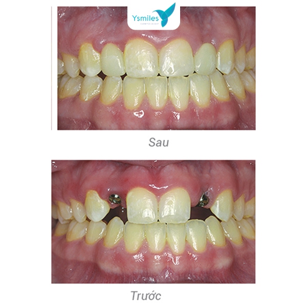 Ysmiles mang đến kết quả an toàn và bền vững khi trồng răng Implant