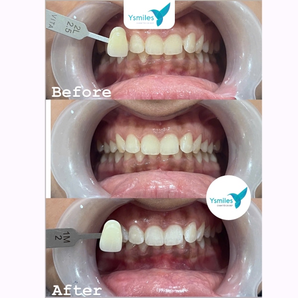 Vì sao tẩy trắng răng không đều màu xuất hiện