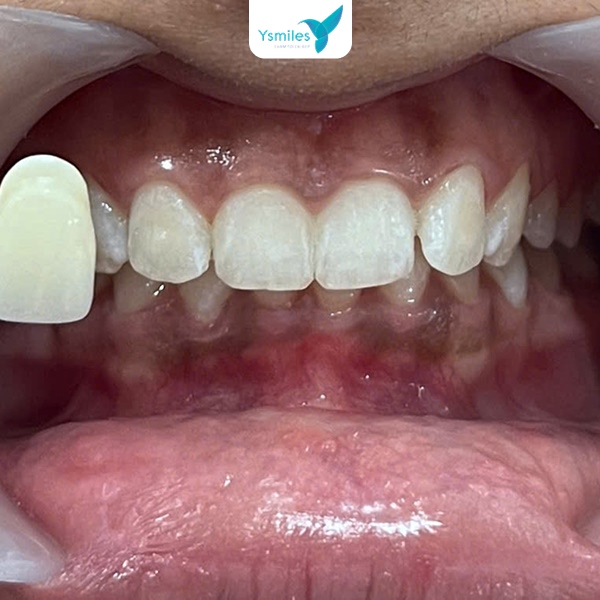 Cách xử lý răng tẩy trắng không đều màu hiệu quả