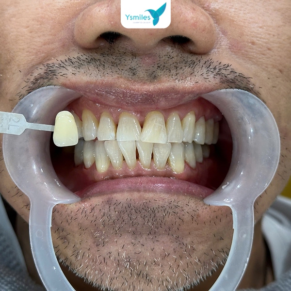 Chi phí khắc phục tẩy trắng răng không đều màu