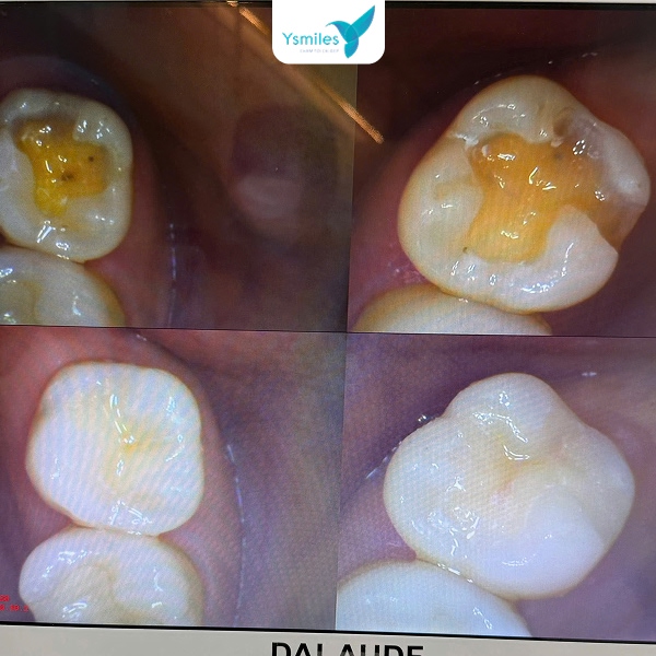 Trám răng giúp khôi phụ chức năng nhai và thẩm mỹ