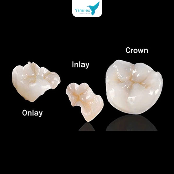 Chăm sóc răng sau khi trám răng giúp tuổi thọ lâu bền