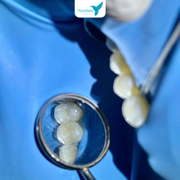 Composite là vật liệu trám răng phổ biến và được đánh giá cao