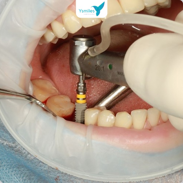 Trồng răng Implant không đau trong quá trình thực hiện nhờ gây tê cục bộ