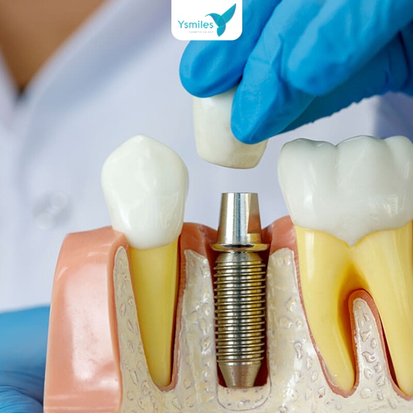 Trồng răng Implant chất lượng an toàn cho sức khỏe răng miệng
