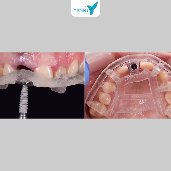 Chi phí trồng răng Implant phụ thuộc vào loại trụ, mão sứ răng và nha khoa 