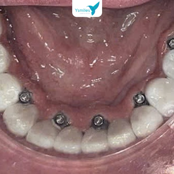 Chọn trụ răng implant chất lượng đảm bảo sử dụng lâu dài