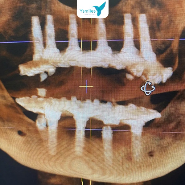 Trồng răng Implant phải được thực hiện kỹ thuật cao an toàn cho ca điều trị