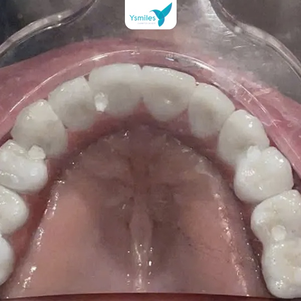 Chăm sóc sau khi trồng răng Implant giúp giữ được tuổi thọ lâu bền 