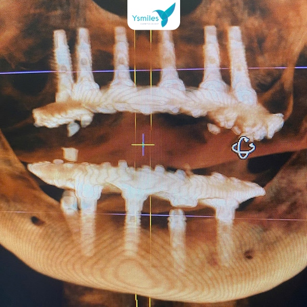 Trồng răng Implant phục hình thẩm mỹ cho răng