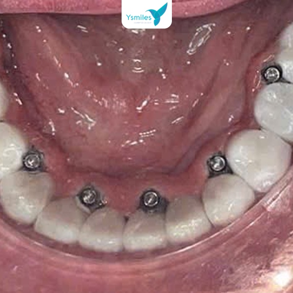 Trụ Implant nha khoa được cấy ghép cố định trong xương