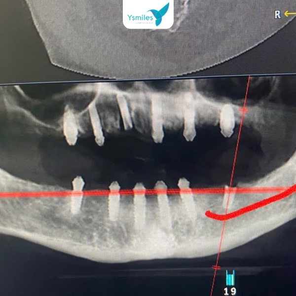 Chụp X-quang kiểm tra vị trí trụ Implant của răng