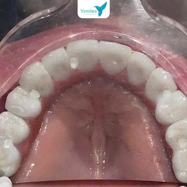 Trồng răng Implant phục hình thẩm mỹ và bảo vệ răng lâu bền