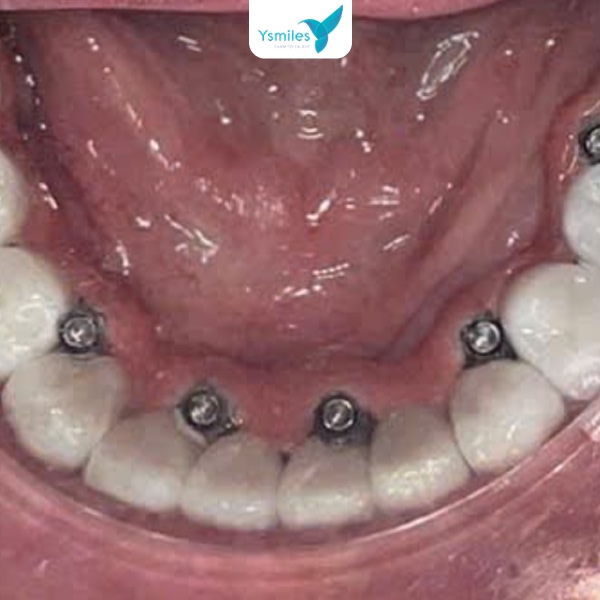 Quá trình cắm trụ trồng răng Implant vào xương hàm
