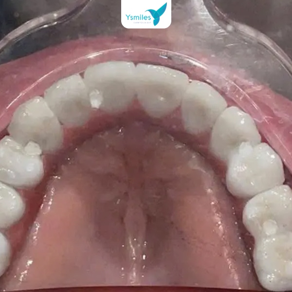 Trồng răng Implant tại Ysmiles an toàn và chất lượng