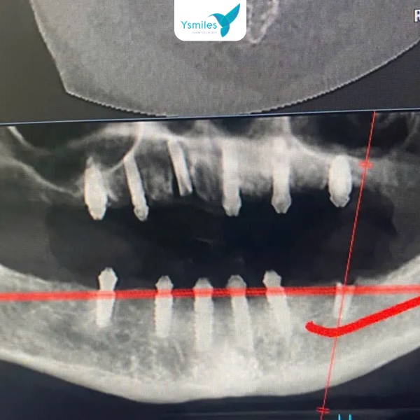 Trồng răng Implant ngăn chặn tiêu xương hàm