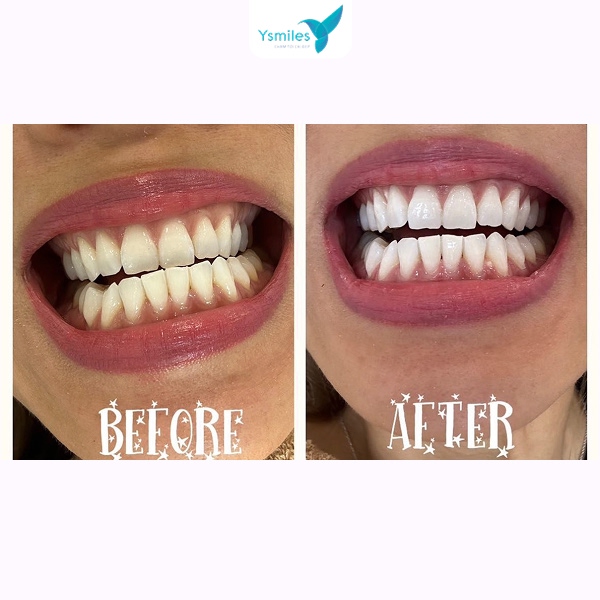 Bề mặt răng trắng đều sau khi thực hiện trám răng Veneer