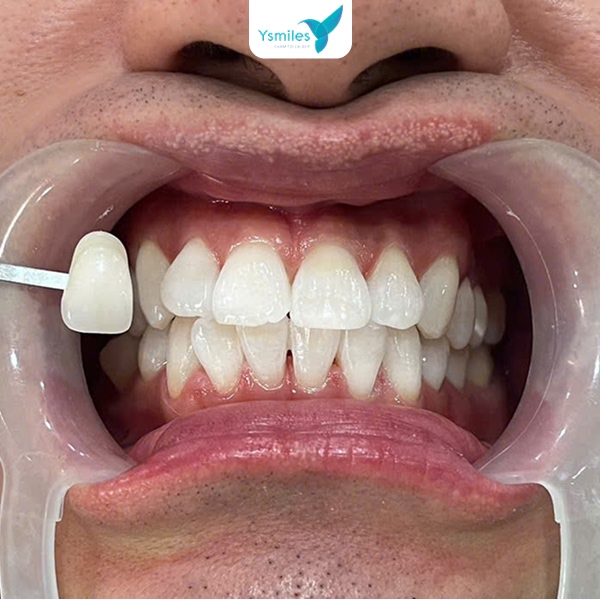 Hình ảnh răng được nâng cấp thẩm mỹ, sáng đẹp sau trám răng Veneer