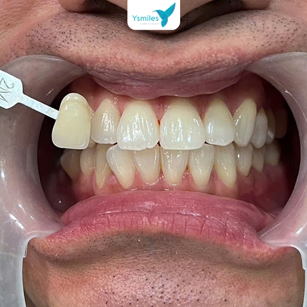 Lựa chọn màu Veneer hài hòa với màu răng thật