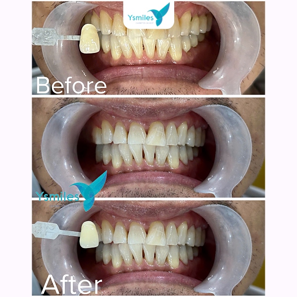 Bề mặt răng trắng đều, sáng khỏe rõ rệt sau quá trình trám Veneer
